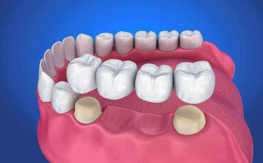 Crowns & Bridges - Riverbend Dentist