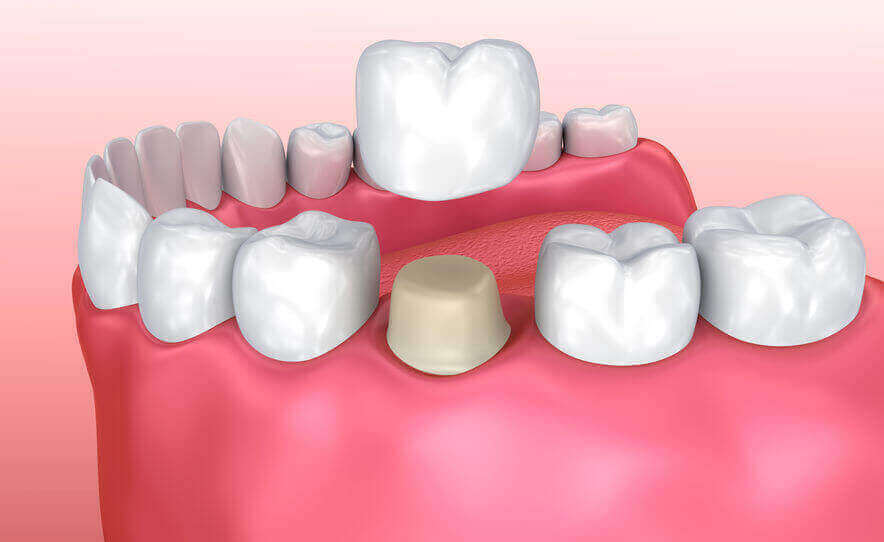 Crowns & Bridges - Riverbend Dentist